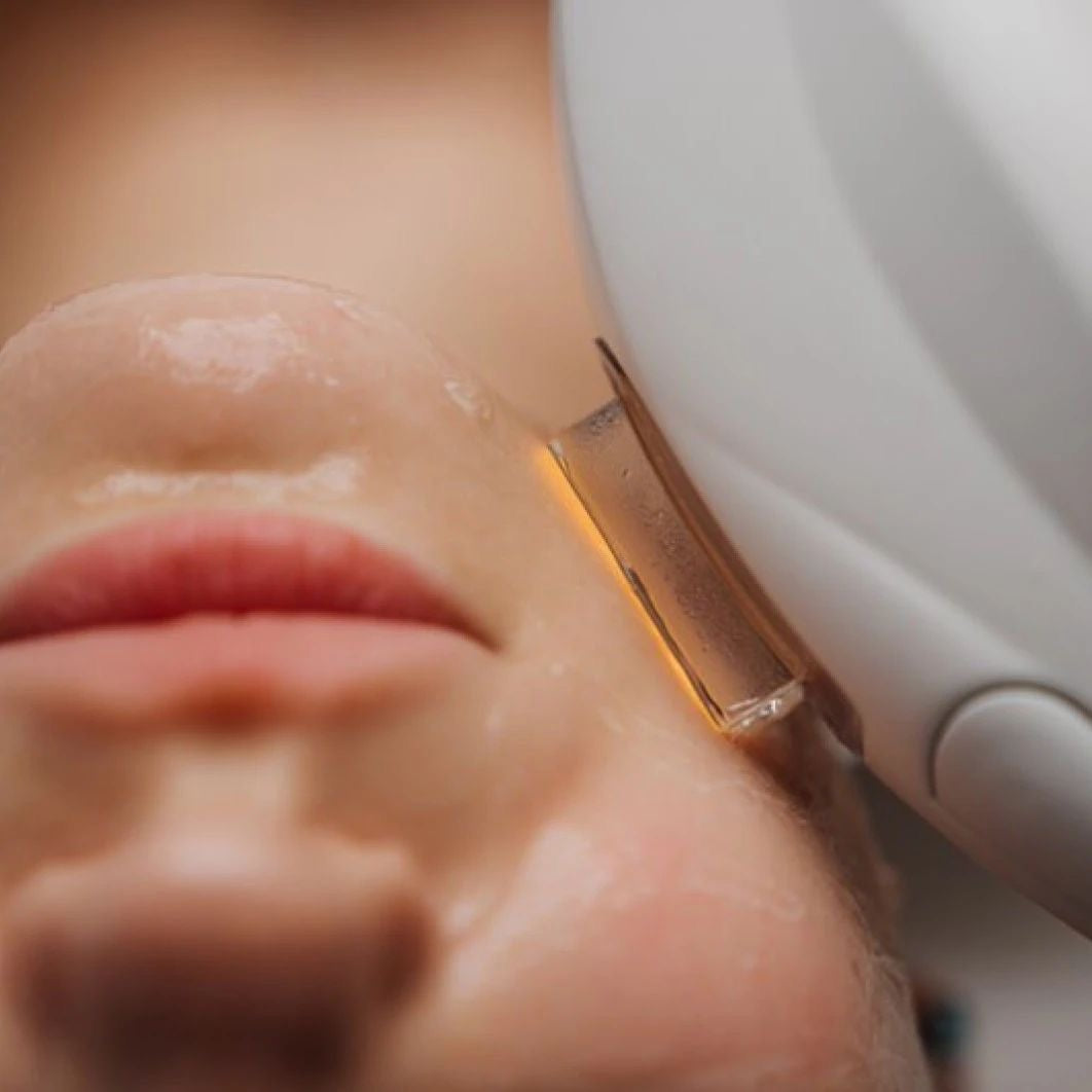 IPL Facial | Luz Pulsada Intensa