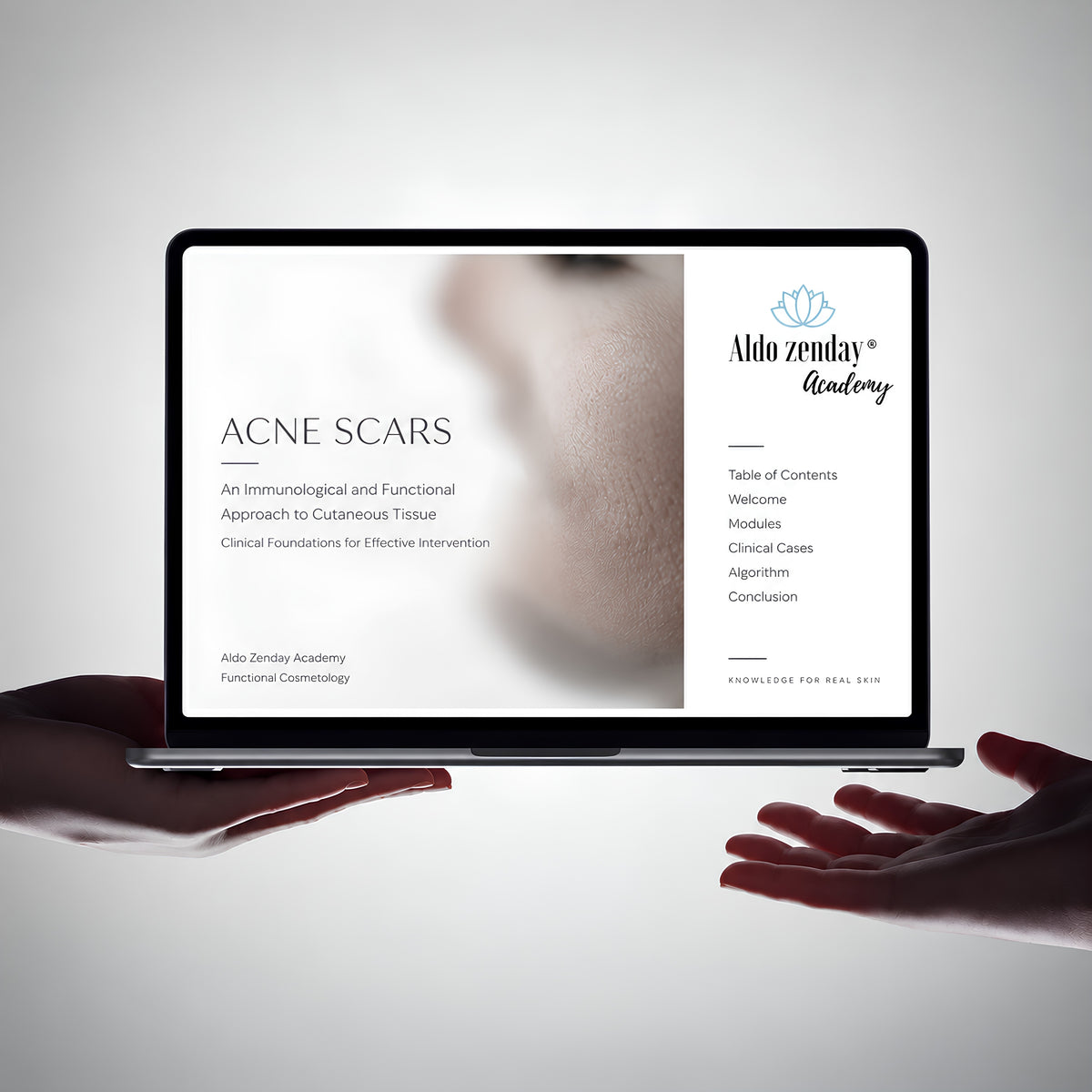 Acne Scars: An Immunological and Functional Approach to Cutaneous Tissue

Clinical Foundations for Effective Intervention