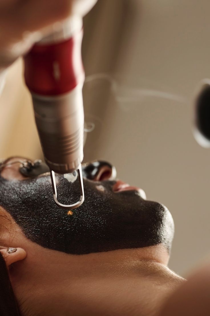 Hollywood Laser Peel (Peeling de Carbón Activado)